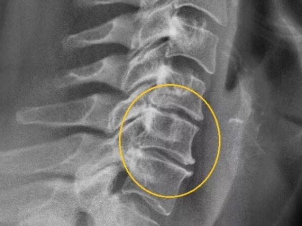 Osteocondrose da columna cervical nun x -ray