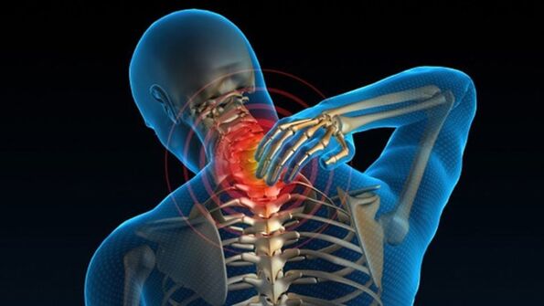 A dor ao xirar o pescozo pode indicar a síndrome vertebral da osteocondrose cervical