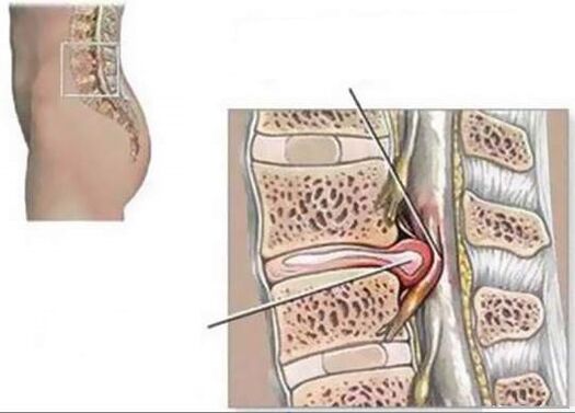 A hernia intervertebral causa dor nas costas