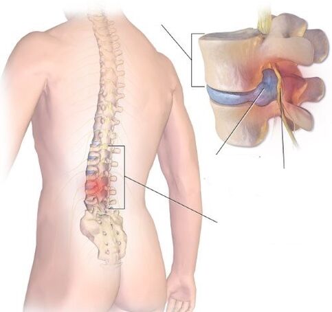 A radiculita é un proceso inflamatorio no departamento de Lumbosacral