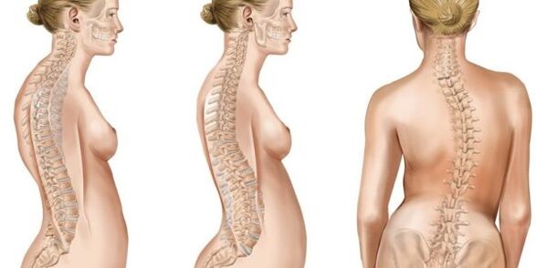 Mesturación de escoliose de discos intervertebrais
