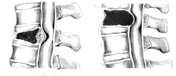 O tumor na columna vertebral é a causa da dor nas costas